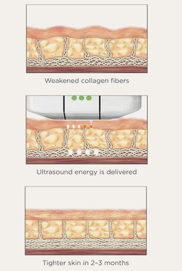 benefits of DERMAL FILLERS IN DUBAI