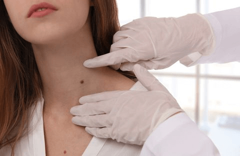 benefits of Skin Tag removal