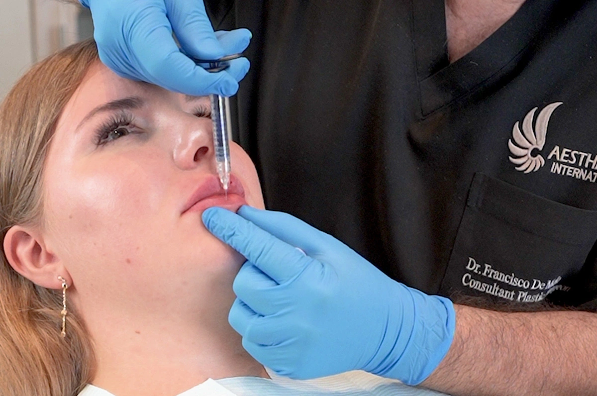 lip filler