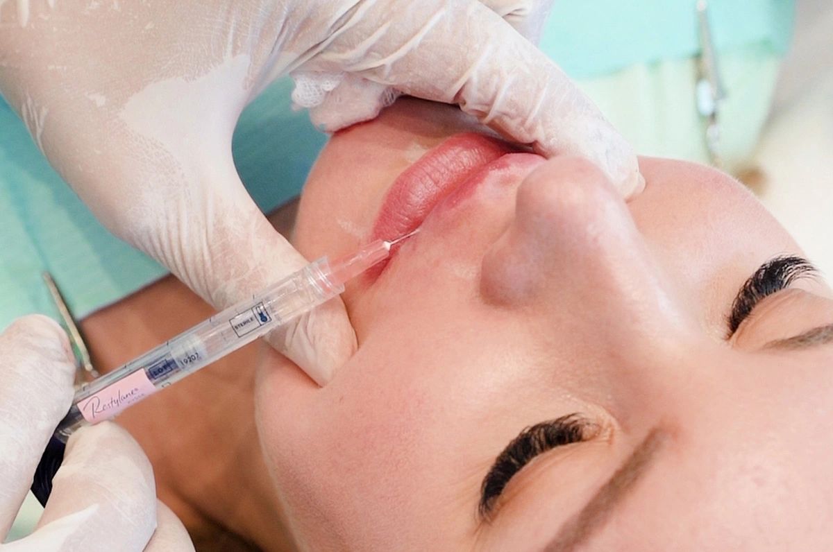 lip fillers