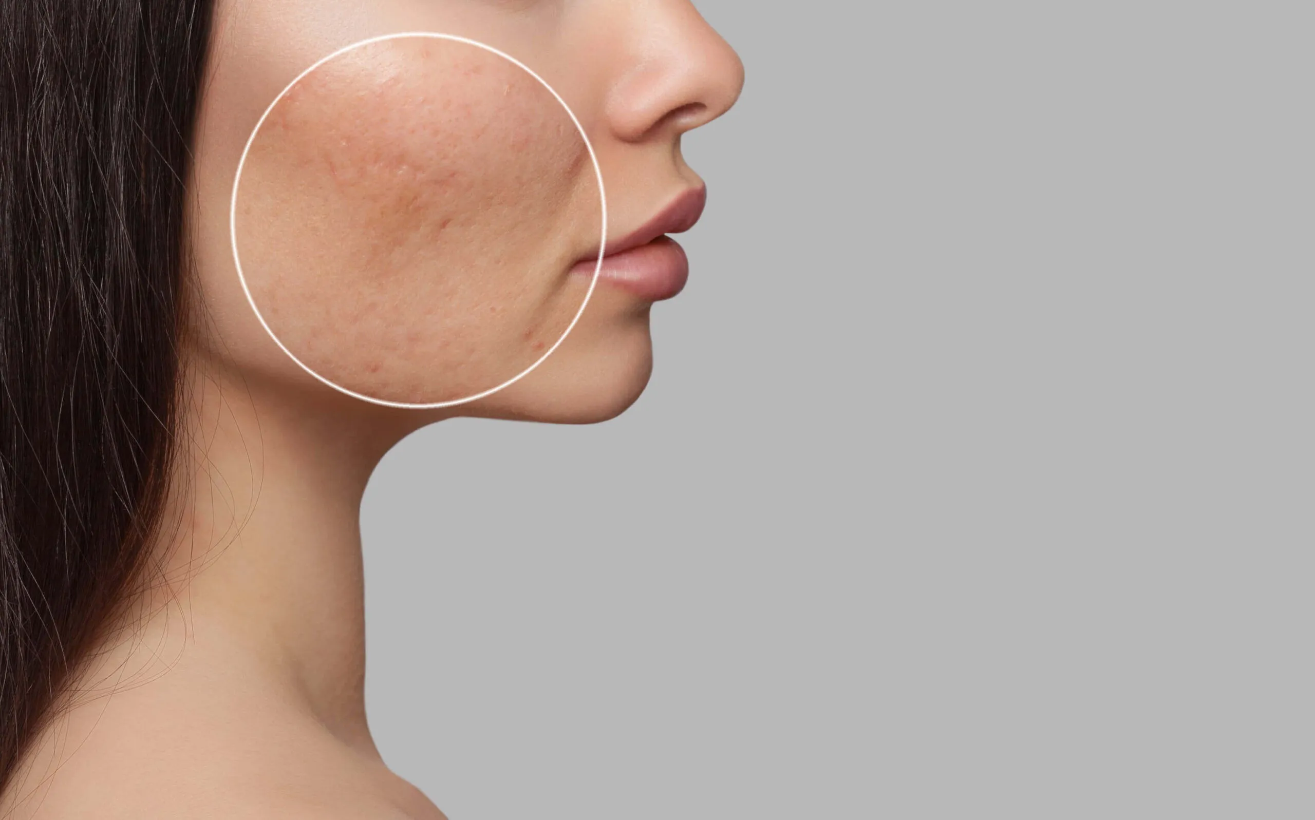 CO2 Fractional Laser Resurfacing Treatment in Dubai