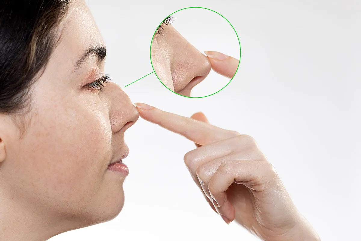 rhinoplasty in Dubai