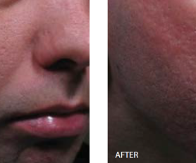 How Does CO2 Laser Work to Treat the Skin