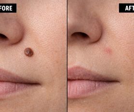 When Should a Mole Be Removed? Signs, Risks and Your Clinical Options